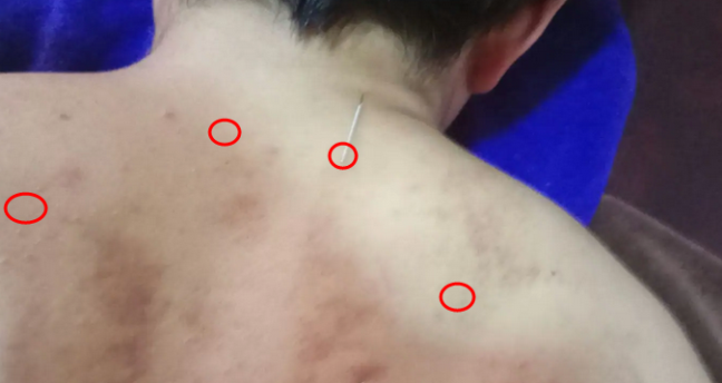 超微针刀改善长年肩颈僵硬不好睡