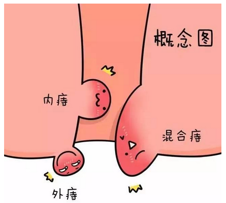 肠躁症多年及痔疮治验