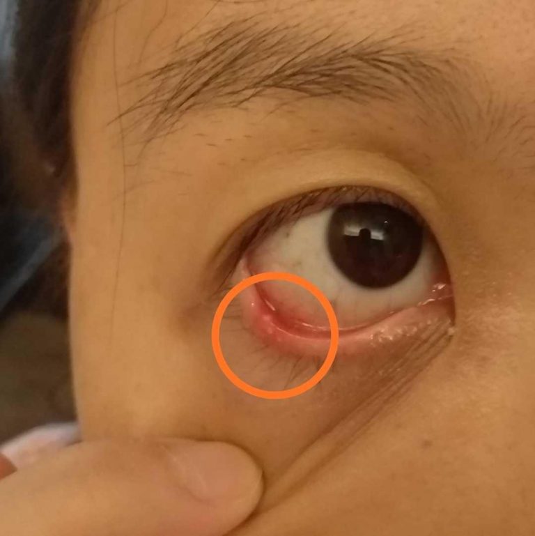 痔疮、麦粒肿、乳房痛治验