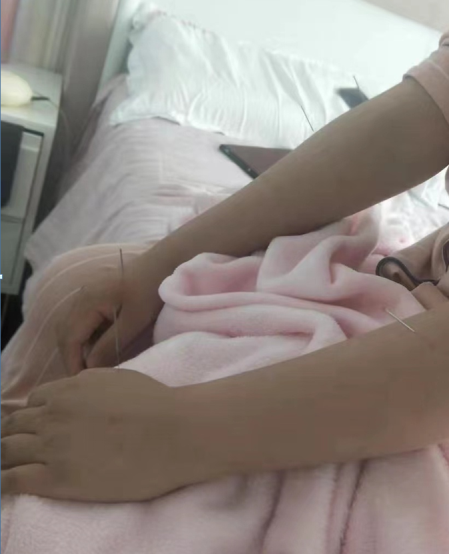 针灸治疗“产后手腕疼痛”立竿见影