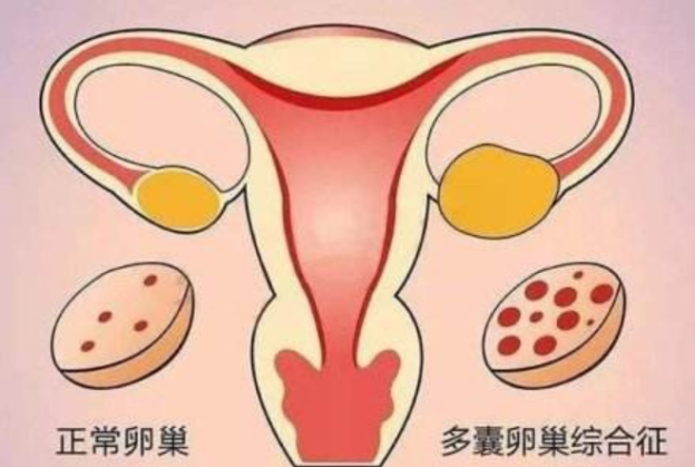 多囊卵巢综合征